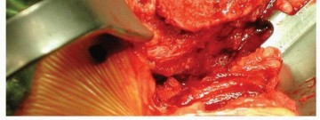 Illustration 7 for Why Polished Tapered Cemented Stems Excel in Hip Replacement