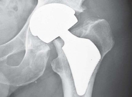 Illustration 29 for The Proxima: Why This Proximally Loading Implant Preserves Bone