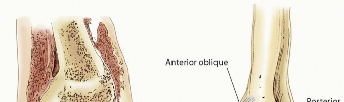Unlock Better Outcomes: Proximal Anteromedial Portal for Chondral Injuries & OCD