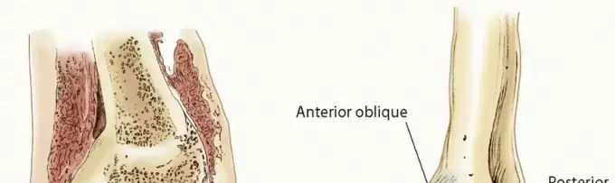 علاج إصابات الغضروف وداء العظم الغضروفي المفصلي بالمنظار: دليلك الشامل لراحة مفاصلك في اليمن والخليج