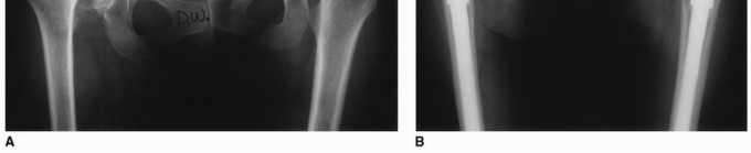 Illustration 5 for Recreate Hip Biomechanics: Modular Stems for Modular Solutions