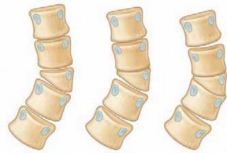 Ensure Nerve Safety: Hemivertebra Excision with a Nerve Root Retractor