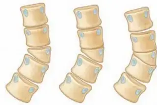 الفقرة النصفية: دليل شامل للمرضى حول أسبابها، أعراضها، وعلاجها الفعال مع الأستاذ الدكتور محمد هطيف