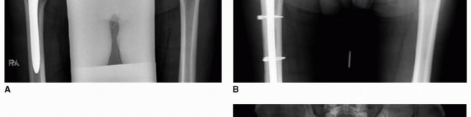 Illustration 14 for PJI of the Hip: Two-Stage Revision: When & How to Prepare