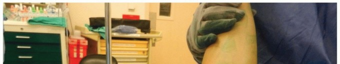 Illustration 12 for Radial Head & Neck Fractures: Mastering ORIF for Best Results