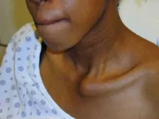 خلع المفصل القصي الترقوي: دليلك الشامل للتشخيص والعلاج والتعافي مع الأستاذ الدكتور محمد هطيف