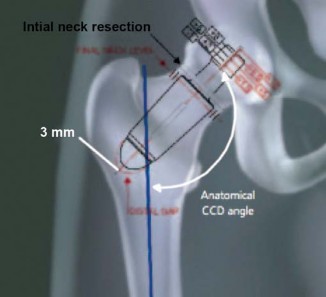 Illustration 6 for The Silent Hip: Achieving a Truly Silent, Pain-Free Joint