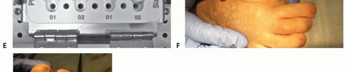Illustration 71 for End Articular Cartilage Loss: Arthrosurface HemiCAP Resurfacing