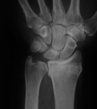 Illustration 10 for Christine M Kleinert Discussion: Solving Difficult Wrist Fractures