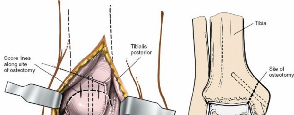 Illustration 37 for Optimized Approaches to the Dorsum of the Foot & Ankle