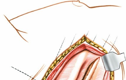 Illustration 314 for Approach to the Lumbar Spine: Mastering Techniques & Anatomy