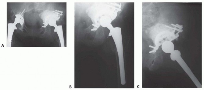 Illustration 2 for Revision Arthroplasty with Acetabular Bone Loss: The Antiprotrusio Cage