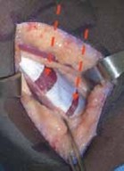 Illustration 19 for Unlocking Mobility: Distal Lengthening for Lateral Hamstring Muscle