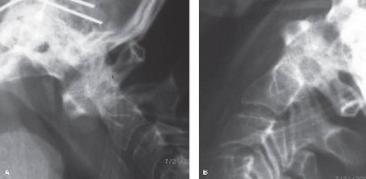 Illustration 34 for Adjacent Segment Degeneration: Your Next Spine Case Solved