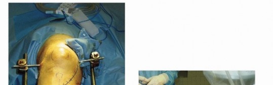 Illustration 50 for Tibia External Fixation: See How Pins Are Placed for Healing