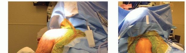 Should You Get Resurfacing of the Glenoid for Shoulder OA?