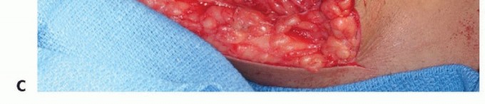 Illustration 27 for Distal Humeral Resection: Safe Techniques for Limb Preservation