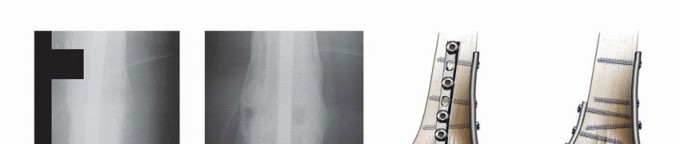 Illustration 12 for Knee Arthrodesis: A Solution for Stable Femur & Tibia Fusion