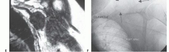 Illustration 17 for Limb-Sparing Resections Around the Shoulder: Optimizing Outcomes