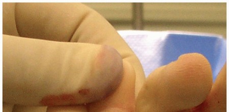 Illustration 32 for Toe Deformity Pain? Rebalance Flexor to Extensor for Relief