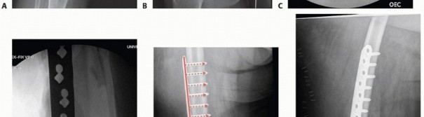 Illustration 26 for Repairing Distal Femur Fractures: Open Reduction & Internal Fixation
