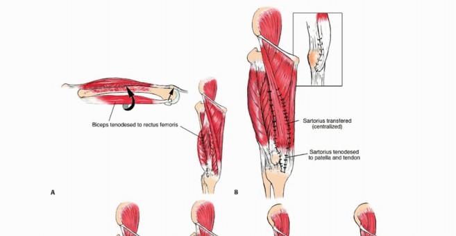Illustration 5 for Limb-Sparing Quadriceps Resection: Superficial Femoral Artery