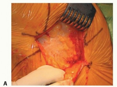 Illustration 24 for Hemiarthroplasty of the Hip: Indications & Types Explained