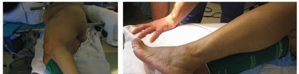 Illustration 5 for Extended Trochanteric Osteotomy: How et al Extended Revision THA Solutions