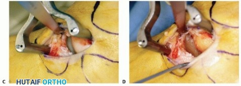 Illustration 58 for Medial Ankle Instability: Find Relief with Reconstruction