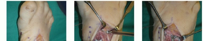 Illustration 52 for Mastering Midfoot Arthrodesis: Protect the Deep Neurovascular Bundle