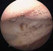 Arthroscopic Lateral Release for ELPS: Clin Orthop Rel Res Solutions