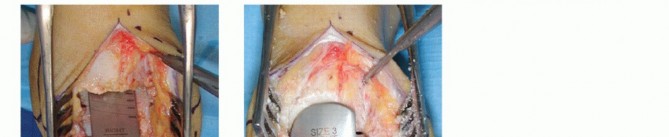 Illustration 23 for HINTEGRA Total Ankle: Unlocking Natural Ankle Movement