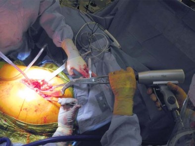 Illustration 33 for Unlock better THA: The technique of short stem for less invasiveness