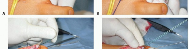 Illustration 27 for How Achilles Tendon Lengthening Fixes Equinocavovarus Foot