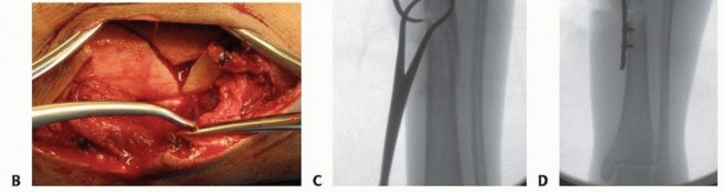 Illustration 33 for Optimizing Intramedullary Nailing for Tibial Shaft Fractures