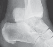 Illustration 3 for Talar Neck Fracture Treatment: Optimizing Recovery with ORIF