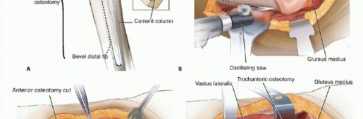 Illustration 2 for Well-Fixed THA Revisions: Precision in the Portion of the Osteotomy