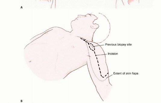 Illustration 22 for Limb-Sparing Resections Around the Shoulder: Optimizing Outcomes