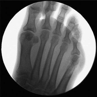 Illustration 3 for Bunionette Treatment: Is Lateral Condylar Resection Right for You?