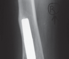 Illustration 20 for Uncemented Stems in Revision: A Guide to Success & Pitfalls