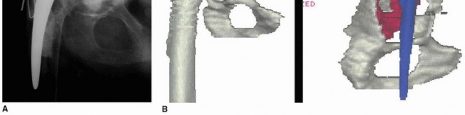 Illustration 2 for Custom Triflanged Devices: Solving Massive Acetabular Bone Loss