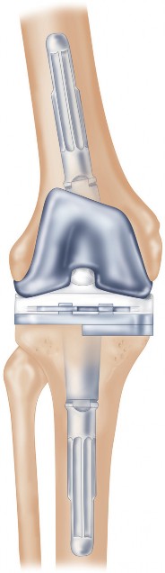 Illustration 4 for Structural Allografting Figure Guide: Solutions for Bone Deficiency