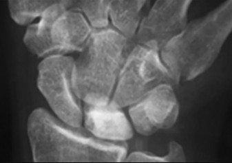 صورة طبية: دليل الأستاذ الدكتور محمد هطيف الشامل لأمراض وإصابات اليد والمعصم في صنعاء