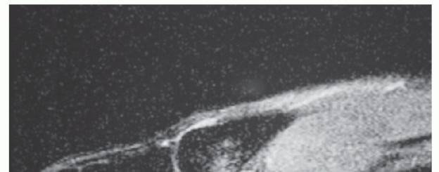 Illustration 12 for Restore Your Foot: Surgical Treatment for Hallux MP Joint Turf Toe