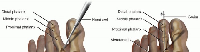 Illustration 14 for Toe Deformity Pain? Rebalance Flexor to Extensor for Relief