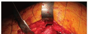 Illustration 26 for Uncemented Acetabular Revision: Optimizing Hemispherical Cup Use