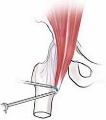 Illustration 11 for J. W. Thomas on Snapping Hip: Causes, Cures & Relief