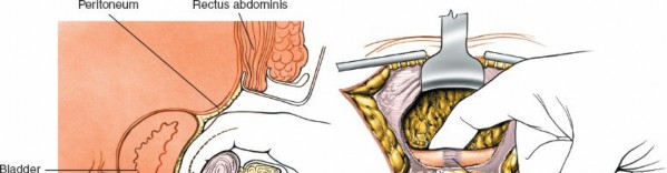 Illustration 21 for Pelvis & Acetabulum Approaches: Unlocking the Posterior Superior Iliac