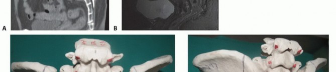 Illustration 50 for Sacral Tumor Surgery: Safeguarding Bowel & Bladder Control