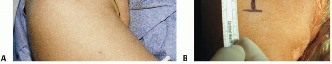 Illustration 13 for Bankart Repair & Inferior Capsular Shift: Solving Shoulder Instability